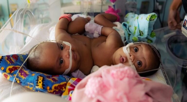 Texas Twins Conjoined at Birth – But What Happened Next Left Everyone Holding Their Breath